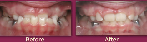 Treatment Photos Anterior Crossbite