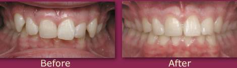 Treatment Photos Overbite