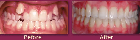 Treatment Photos Posterior Crossbite